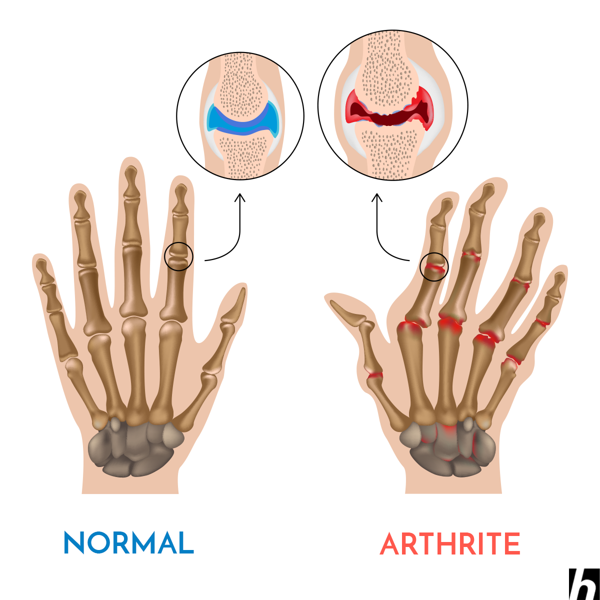 Arthrite.png